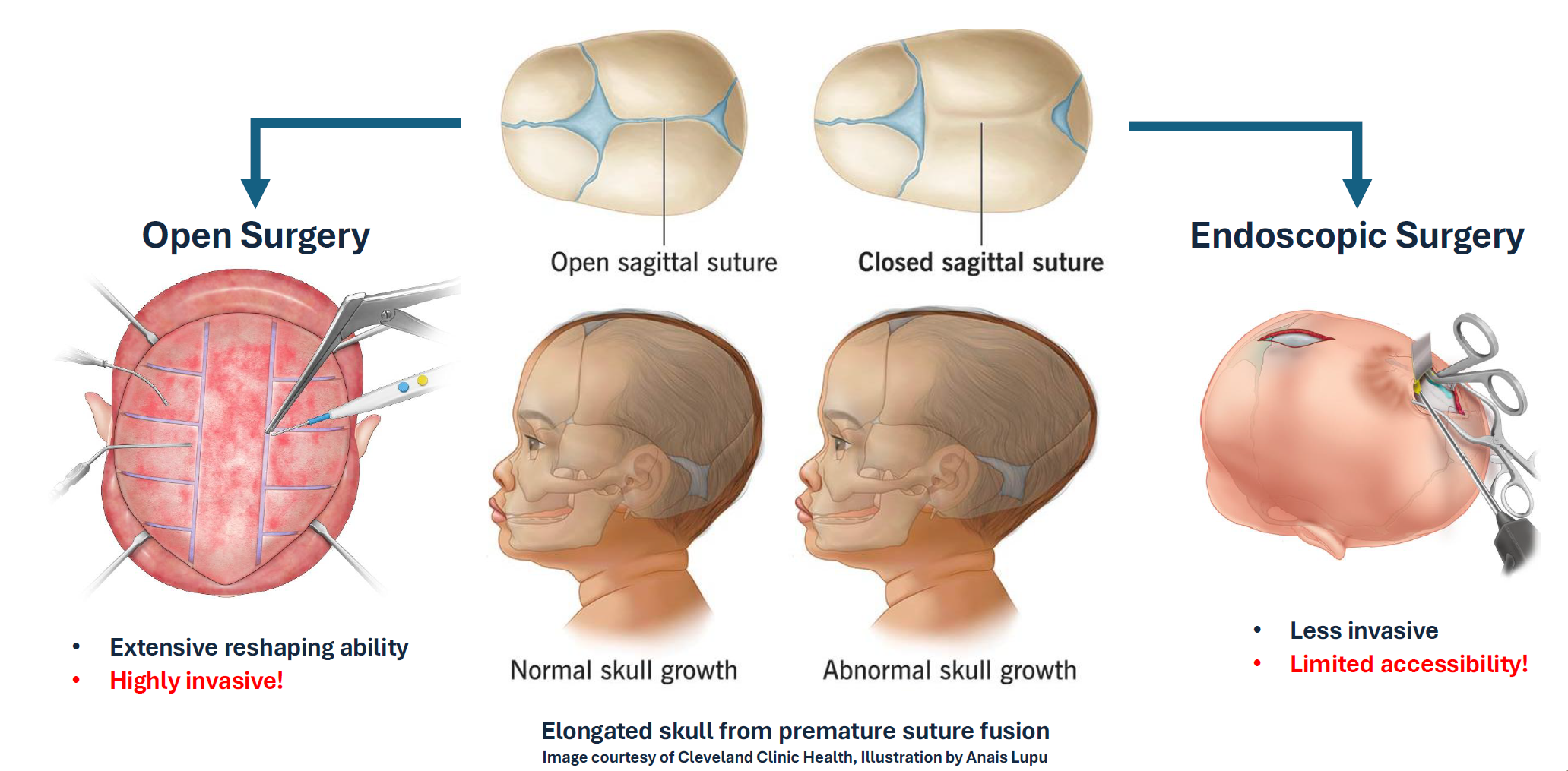 Craniosynostosis surgery: open vs. endoscopic approach